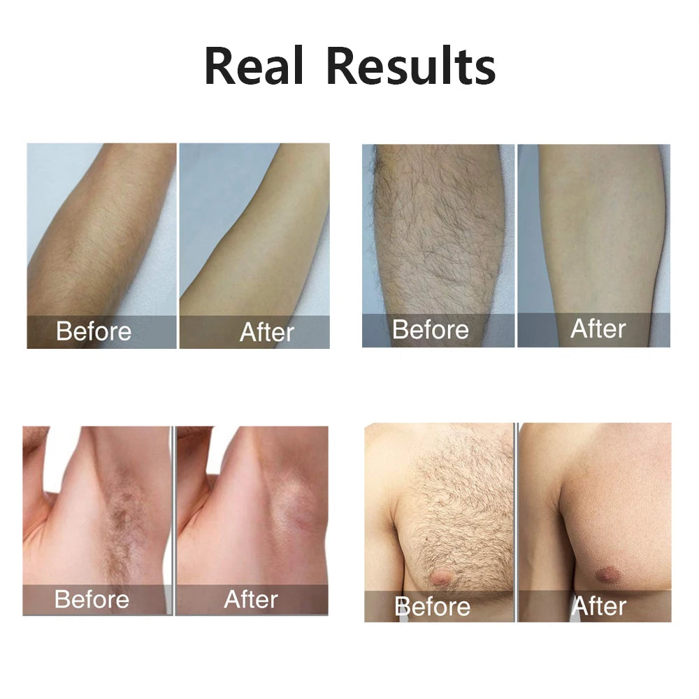 Laser Epilator IPL Hair Removal for Women