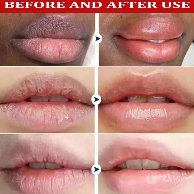 Lip Lightening Balm – Melanin Removal, Exfoliating & Moisturizing