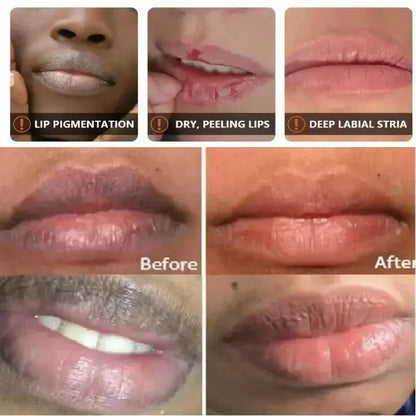 Lip Lightening Balm – Melanin Removal, Exfoliating & Moisturizing